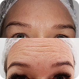 ANTES-E-DEPOIS-BOTOX