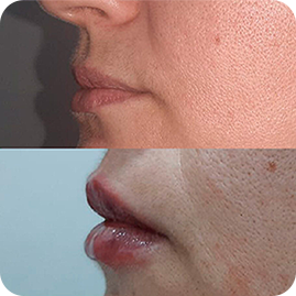 ANTES-E-DEPOIS-PREENCHIMENTO-LABIAL-1