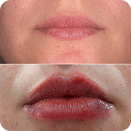 ANTES-E-DEPOIS-PREENCHIMENTO-LABIAL-2