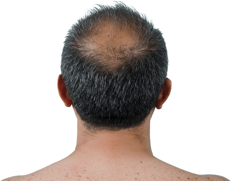 Mesoterapia-Capilar